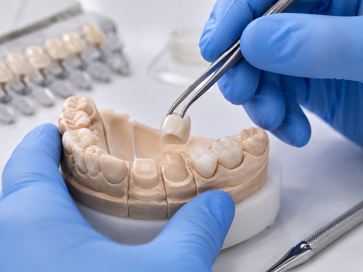 Zirconia crown fitting procedure at Elysian Dental Care, Kondapur