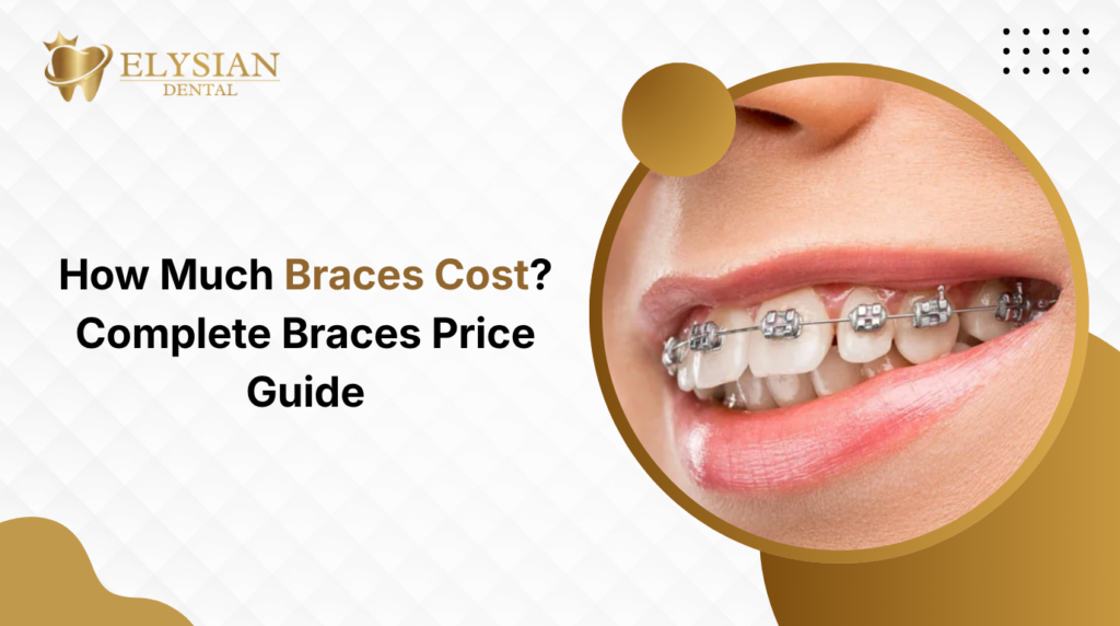Braces Cost
