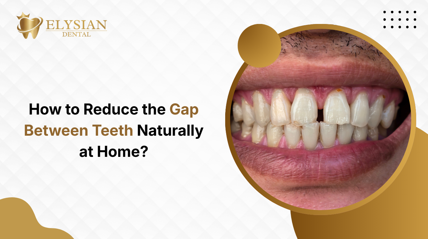 How to Reduce the Gap Between Teeth Naturally at Home?