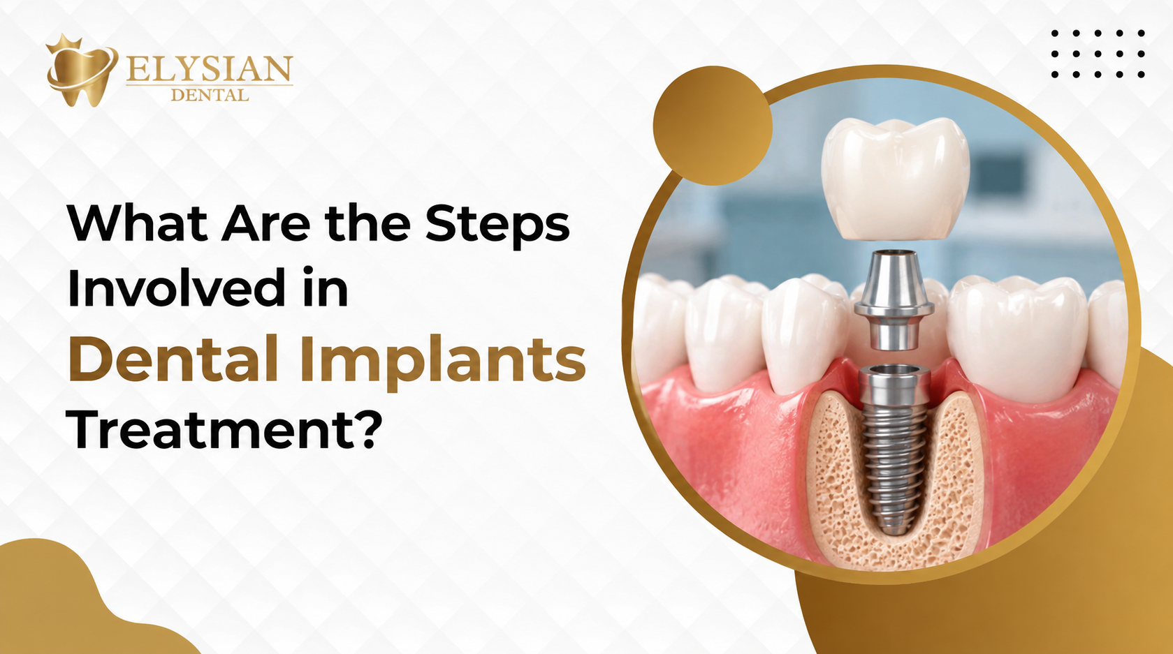 What Are the Steps Involved in Dental Implants Treatment?
